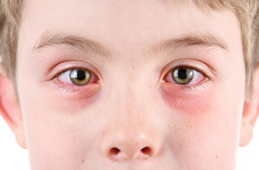 Pink Eye Symptoms