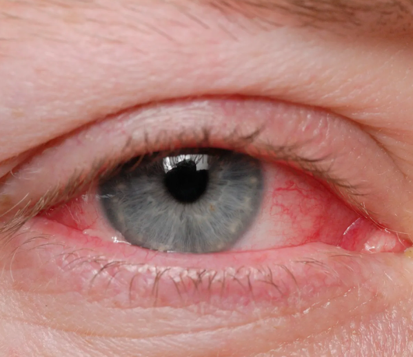 Pink Eye Symptoms